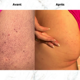 Exfoliation du corps au gant en soie BelucciSkin contre kératose pilaire et poils incarnés